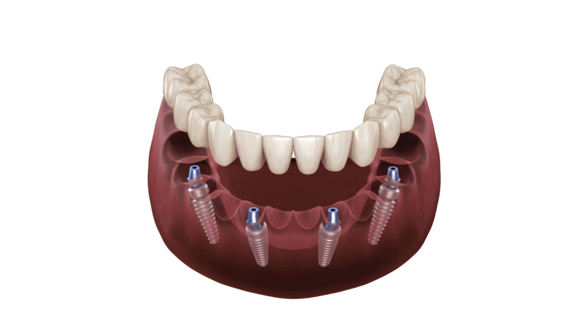 Illustration of a full arch implant bridge supported by four implants
